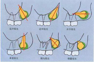 智齿到底是什么，有必要拔吗？