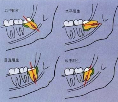 智齿到底是什么，有必要拔吗？