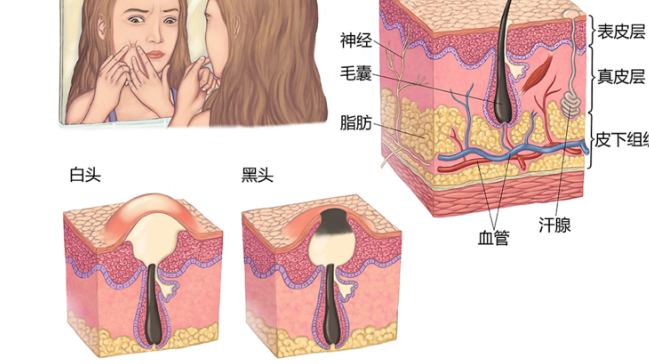 鼻子上长痘痘怎么快速消除