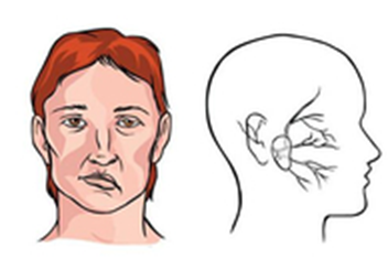 哪些是面瘫患者的临床表现？
