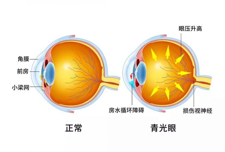 青光眼患者手术后应该怎样护理？