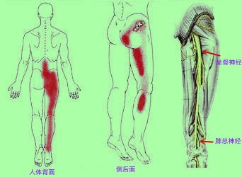 请问治疗腰椎间盘突出有什么方法最好