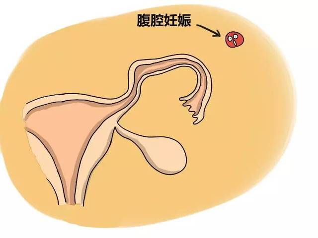 腹腔妊娠是一种比较少见的以为妊娠，具体是什么意思？